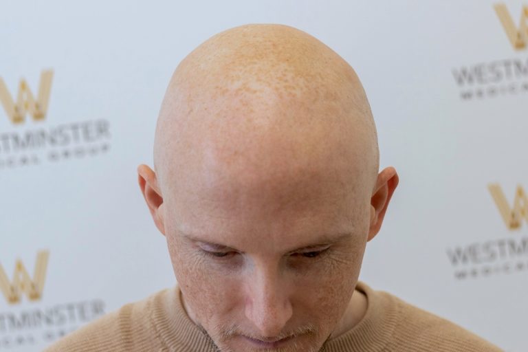 Close-up of a bald man's head viewed from above, showing his forehead and scalp with a background featuring a blurred logo wall. His eyes are looking downward, and he has light facial hair. This