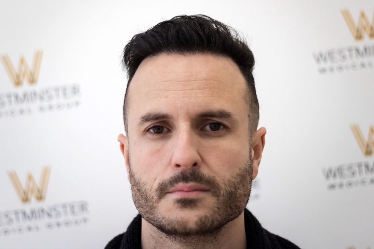 Close-up portrait of a man with dark hair styled in a pompadour, showcasing signs of male pattern baldness, light stubble, and a serious expression, standing against a background with the logo