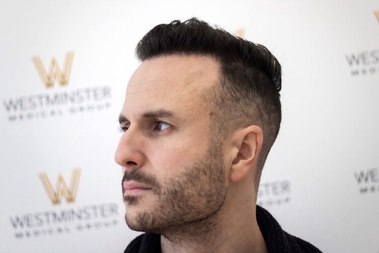 A man with a styled mohawk haircut, possibly exploring hair regrowth options, is looking to the side. He is in front of a backdrop with "Westminster Medical Group" logos.