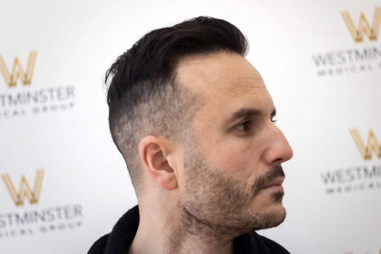 A man with a stylish undercut hairstyle at a Westminster event, shown in profile against a background with repeating logos. He has dark hair and is demonstrating male pattern baldness, wearing a black sweater.