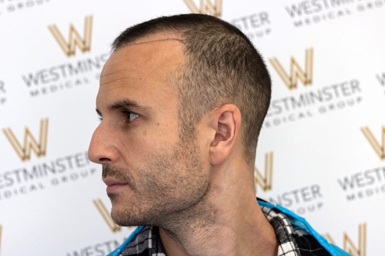 A man with a receding hairline and short dark hair, possibly considering a hair implant, looks to his left against a backdrop featuring the "Westminster Medical Group" logo. He wears a blue