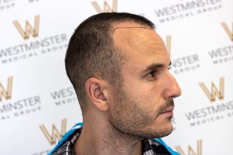 Side profile of a man with a closely cropped haircut, sitting in front of a backdrop with the "Westminster Medical Group" logo repeated, which specializes in hair replacement.