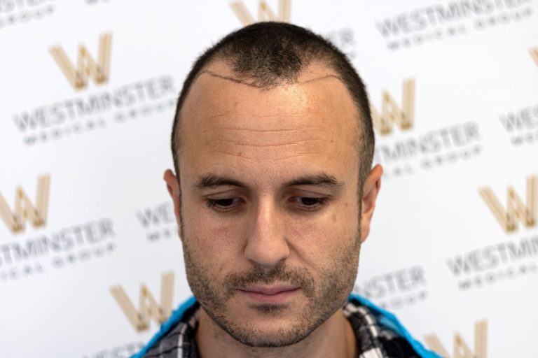 A man with a receding hairline and short dark hair, possibly considering hair replacement, looking down, standing in front of a backdrop featuring the Westminster Medical School logo. He wears a blue plaid