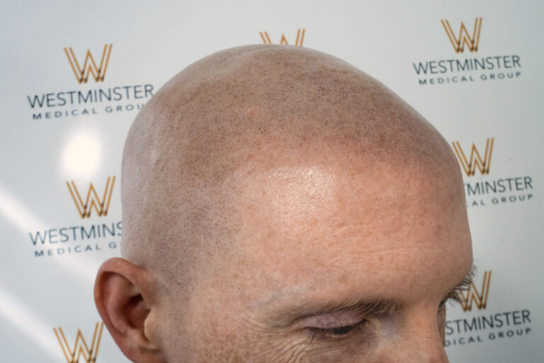 Close-up view of a bald man's head from the side, with a background featuring the logo of Westminster Medical Group, specialists in hair replacement.