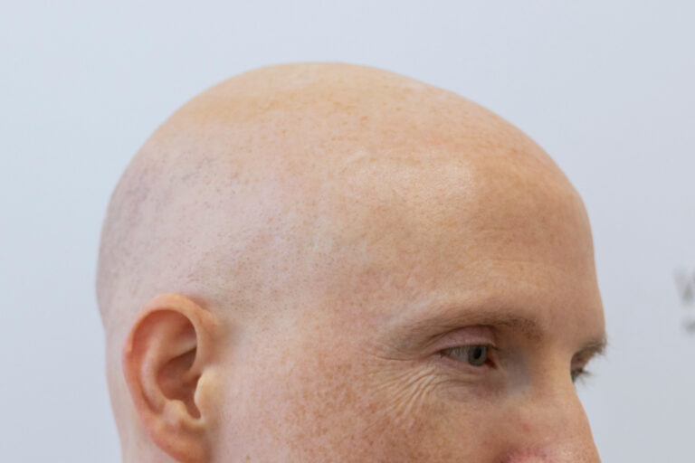 Close-up of a person's head, focusing on a bald scalp with visible details of skin texture indicative of male pattern baldness. The side view shows part of the ear and one eye, implying a