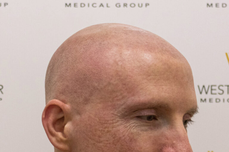 Close-up of a bald person's head at an event, showcasing their scalp and profile against a backdrop with medical group logos specializing in female hair loss.