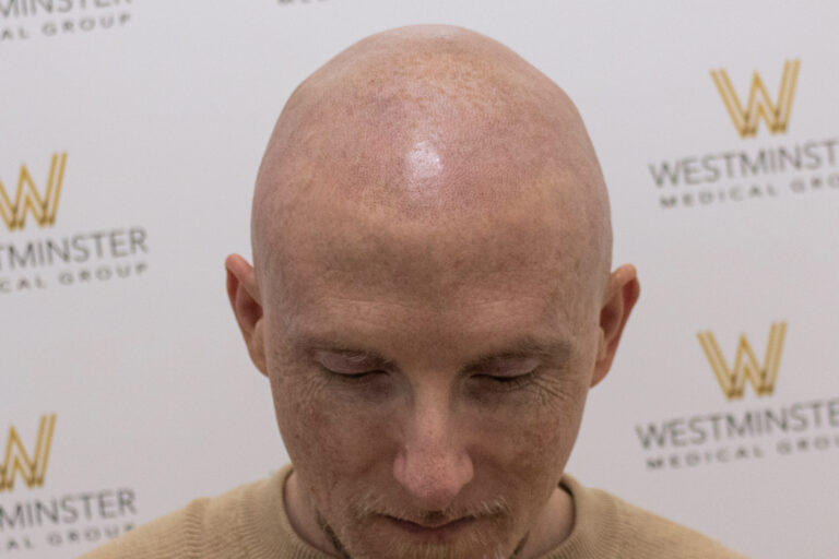 Close-up of a bald man's head looking downward, with a background featuring a blurred logo of Westminster Medical Group specializing in hair replacement.