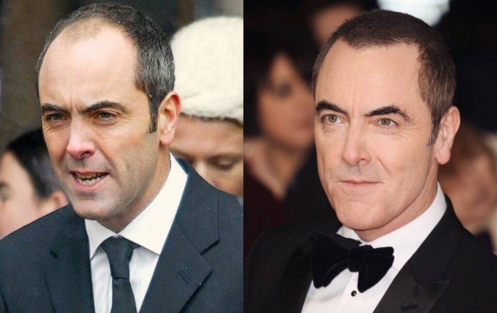 Split-panel image showing the same man twice; on the left, he looks serious in a business suit sporting hair surgery, and on the right, he appears polished in a tuxedo at a formal