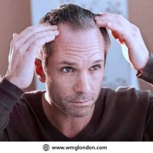 A middle-aged man experiencing male pattern baldness, looking concerned, holds his head with both hands. He has a pensive expression. The backdrop is blurred, and there's a watermark reading "www