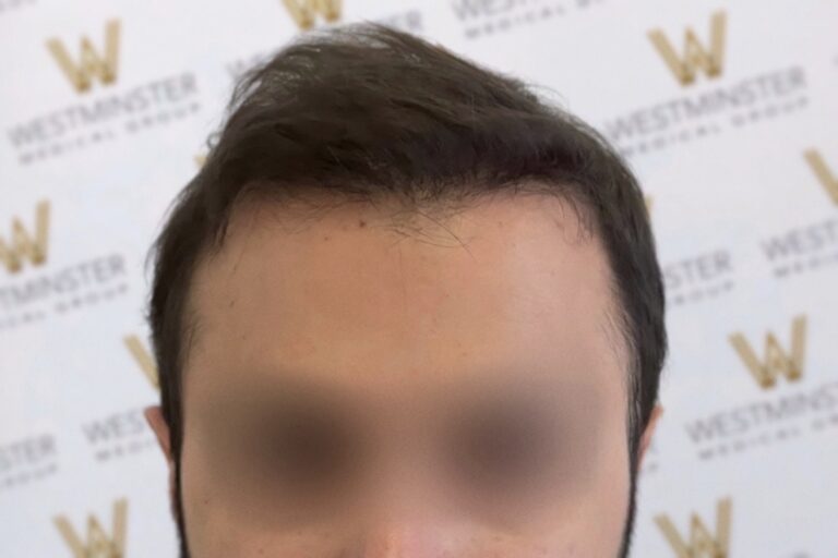 Close-up photo showing evidence of hair implant on a person's forehead and hairstyle, with their eyes blurred for privacy, against a background featuring the repeated logo of "Westminster".