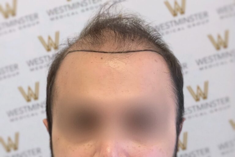 A close-up photo of a person with male pattern baldness on the top of their head, standing against a background with the 'Westminster' logo repeated. The person's eyes are blurred for privacy