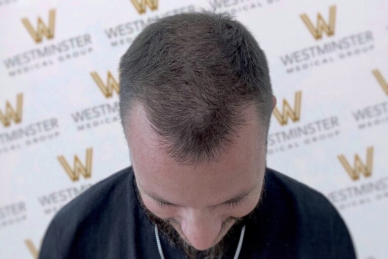 Top view of a person's head showcasing early stages of male pattern baldness with thinning hair on the crown against a backdrop with the Westminster logo.