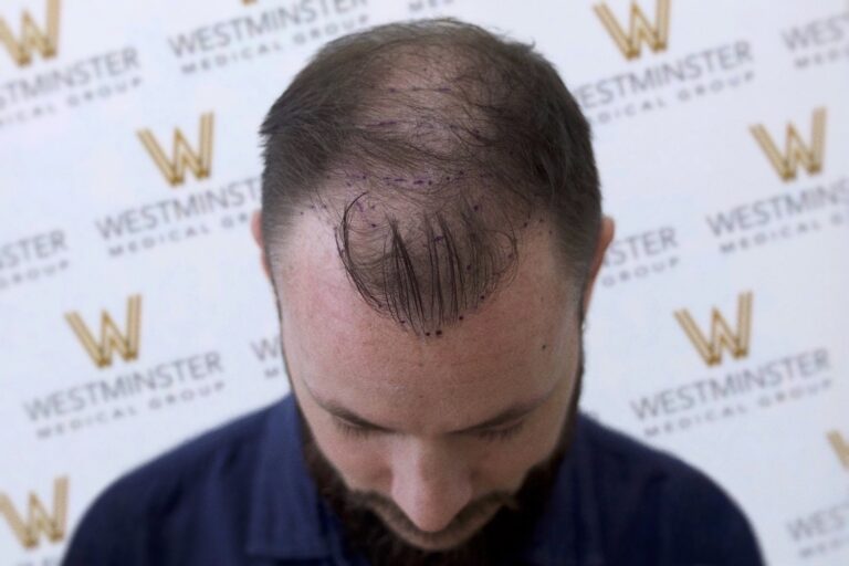 A man with male pattern baldness, viewed from above, showcasing a heart design drawn on his scalp. In the background is a banner with repetitive "Westminster" logos.