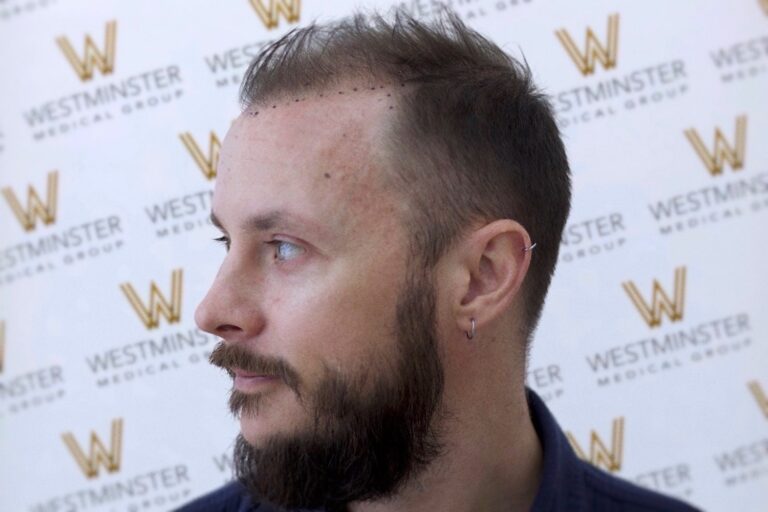 Side profile of a man with a beard and a mohawk, showing signs of male pattern baldness, standing in front of a backdrop with "Westminster" logos. He has a stud e