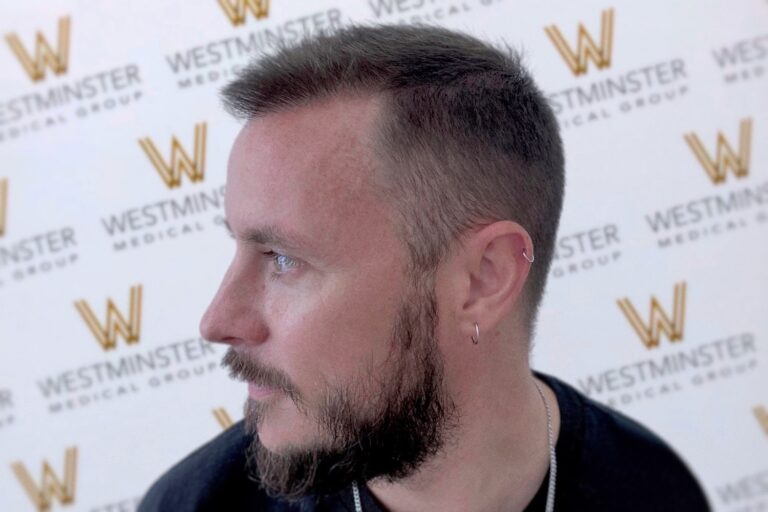 Profile view of a man with styled beard and trendy haircut, featuring a fade, addressing male pattern baldness. He wears a black shirt and an earring, against a background with the Westminster Medical Group