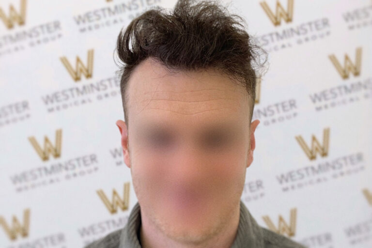 Man with blurred face against a backdrop with "westminster" logos, featuring dark, tousled hair and a grey sweater, possibly experiencing male pattern baldness.