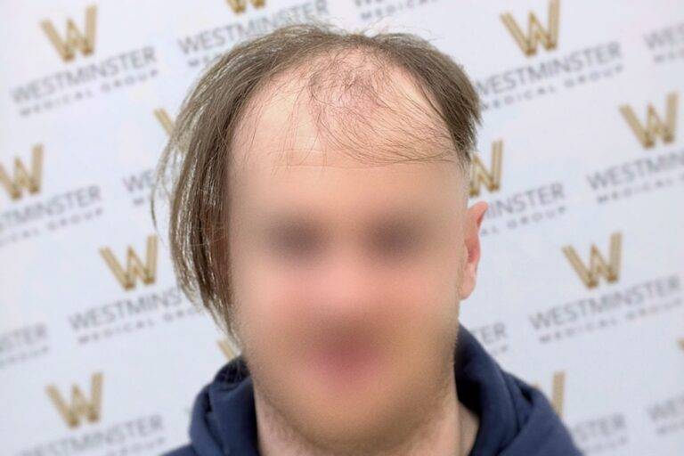 hair transplant london