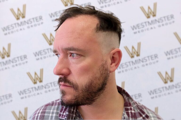 A man with a unique side-parted undercut hairstyle, possibly considering hair replacement options, looks to the side against a backdrop with the "Westminster Medical Group" logo. He has a beard and is