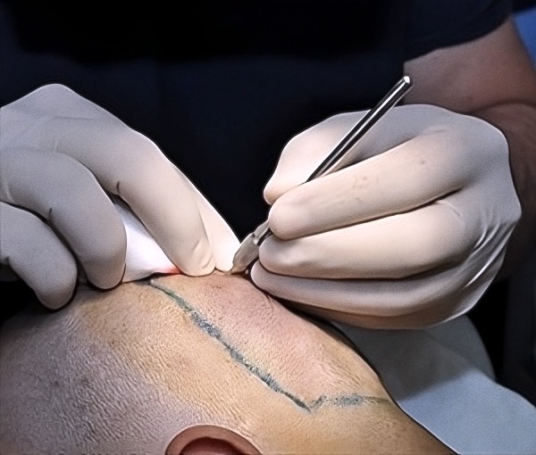 Manual-Hair-Transplant-Clinic-London