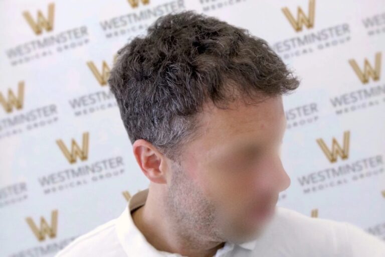 A blurred photo of a man with his face obscured, focusing on his curly hair, against a background with a repeating "westminster" logo. He is wearing a white shirt and displaying signs of early