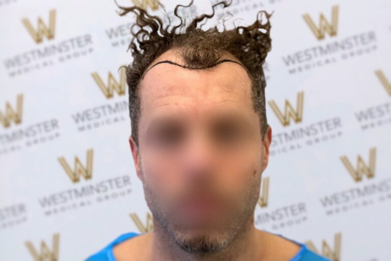 Close-up of a person with blurred facial features, showcasing distinctive curly hair despite male pattern baldness, against a backdrop with a “westminster” logo repeated.
