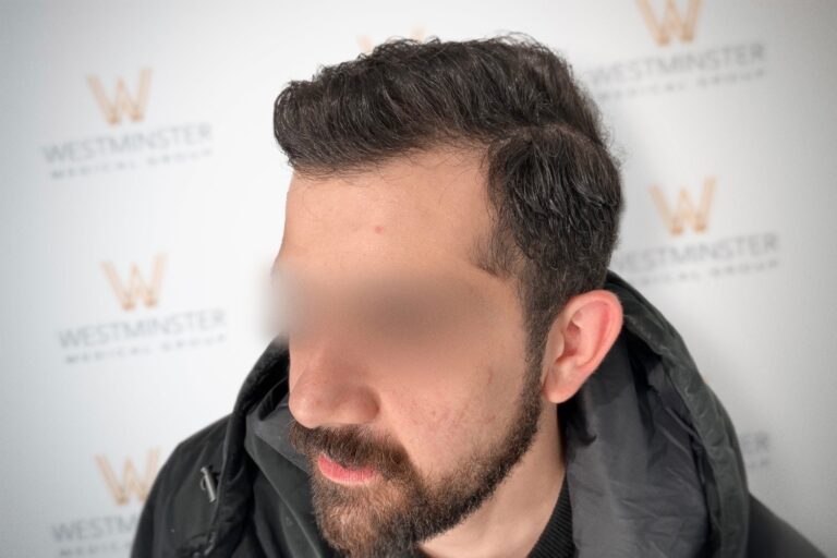 A man's blurred face is centered against a backdrop with the "westminster" logo repeated. He wears a white shirt, with clear focus on his curly hair and background, addressing male pattern baldness