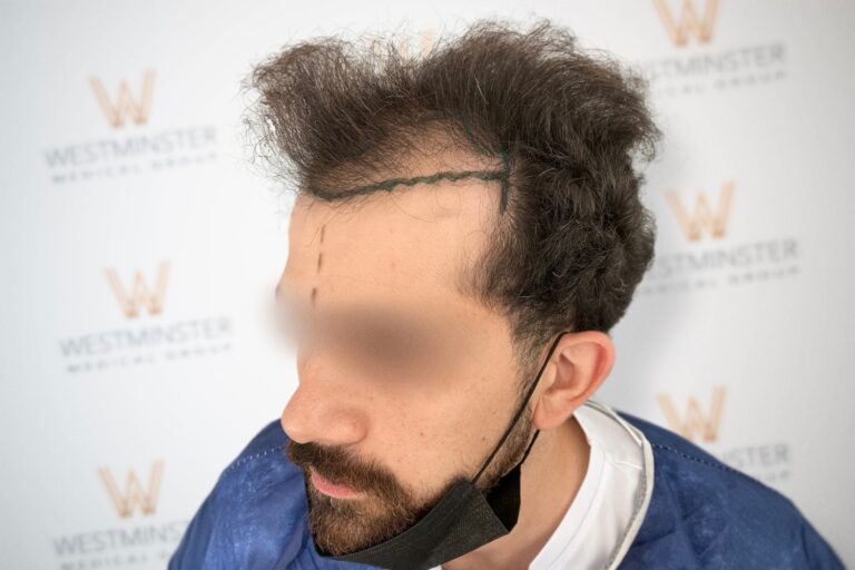 Close-up of a person with blurred facial features, showcasing distinctive curly hair despite male pattern baldness, against a backdrop with a “westminster” logo repeated.