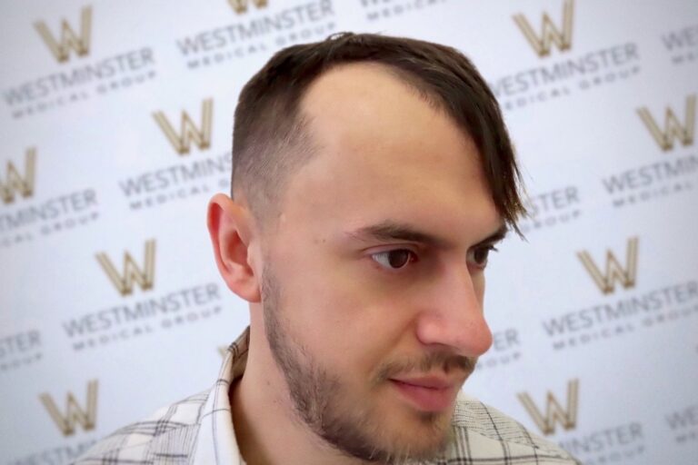 A man with a distinct side-parted undercut hairstyle, looking to the side in front of a background with the repeated "westminster" logo following his recent hair surgery.
