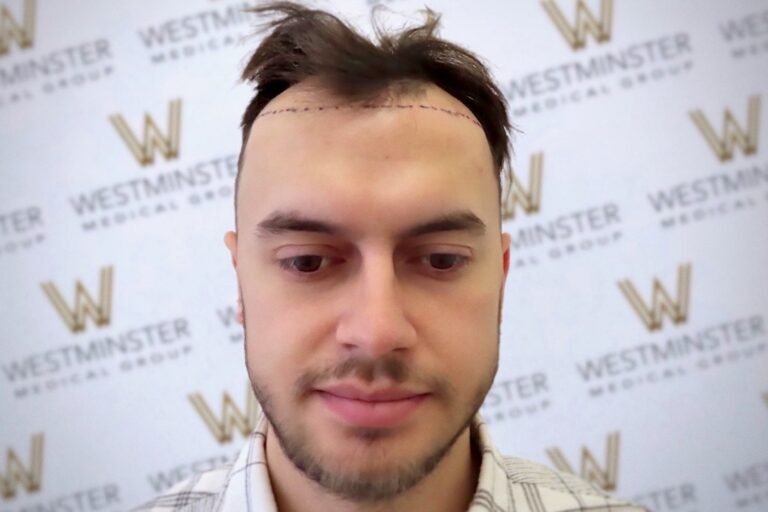 A man with male pattern baldness marked with a dotted line, possibly for a hair transplant consultation, standing in front of a backdrop with the Westminster Medical Group logo.