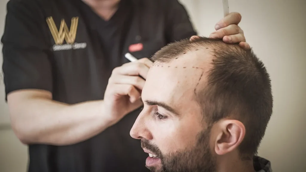A man undergoing a hair replacement procedure in a clinic, with a professional using a marker on his partially bald head to outline areas for treatment.