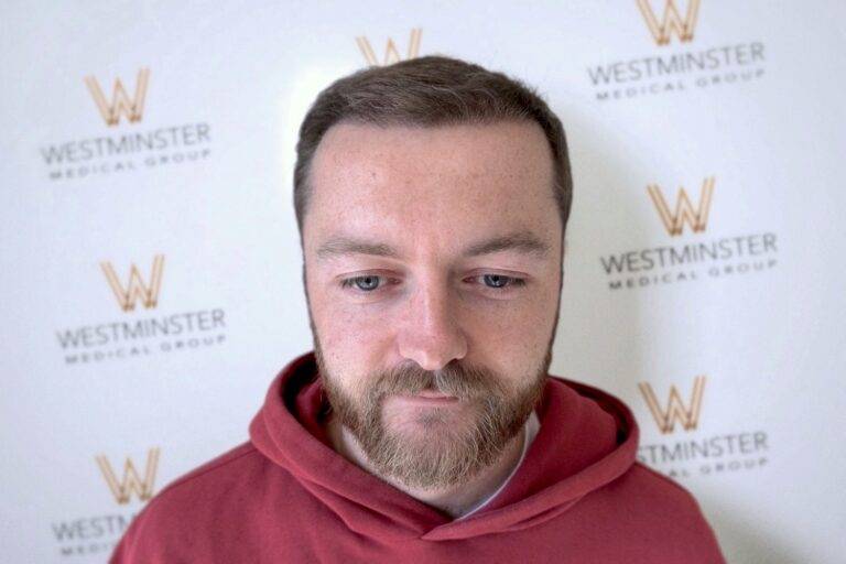 A man with a beard and mustache, wearing a red hoodie, stands in front of a wall with a repeated logo of "Westminster Medical Group," which specializes in hair regrowth.