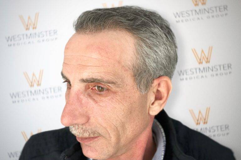 Hair Transplant Results 34