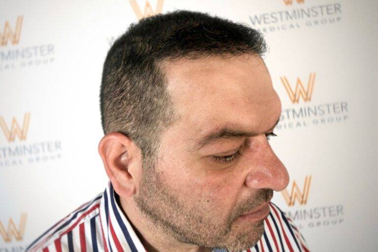Hair Transplant Results 40