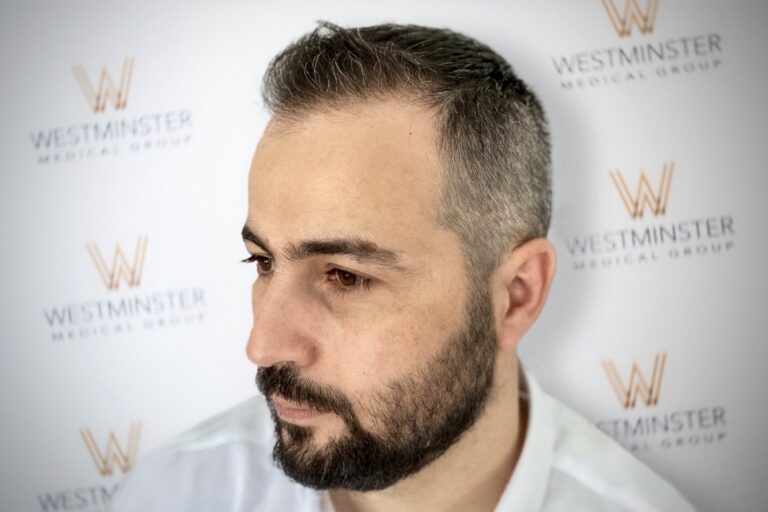 A man with a meticulously groomed beard and short hair stands before a backdrop featuring the Westminster Medical Group logo, focusing thoughtfully to his left, representing their hair transplant services.