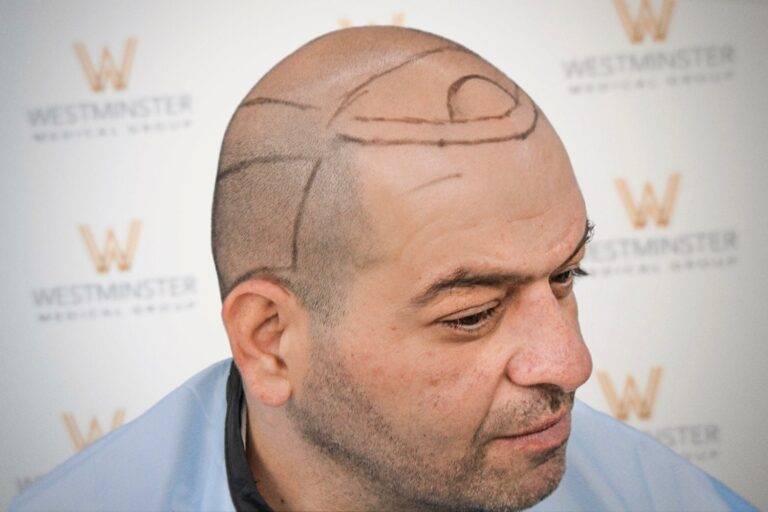 Hair Transplant Results 39