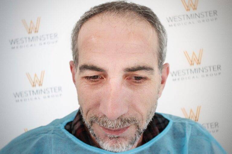 Hair Transplant Results 31