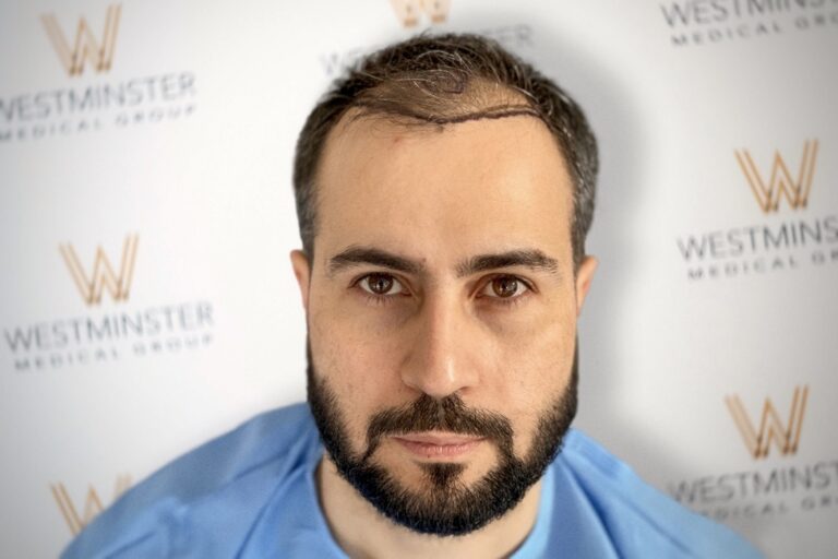 Man with a beard in blue scrubs, looking directly at the camera, set against a backdrop with Westminster Medical Group logos, specializing in hair transplant services.