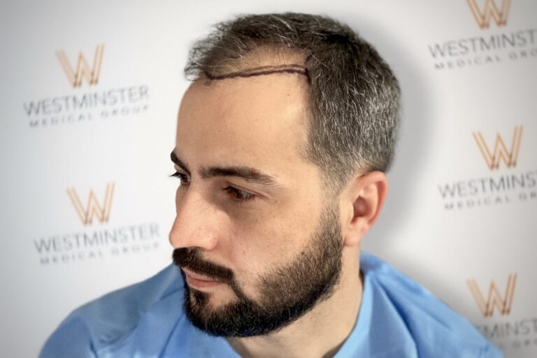 A man with a marked incision line on his scalp, likely for a hair replacement procedure, is photographed in front of a backdrop with the Westminster Medical Group logo.