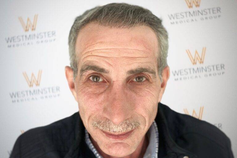 Hair Transplant Results 32
