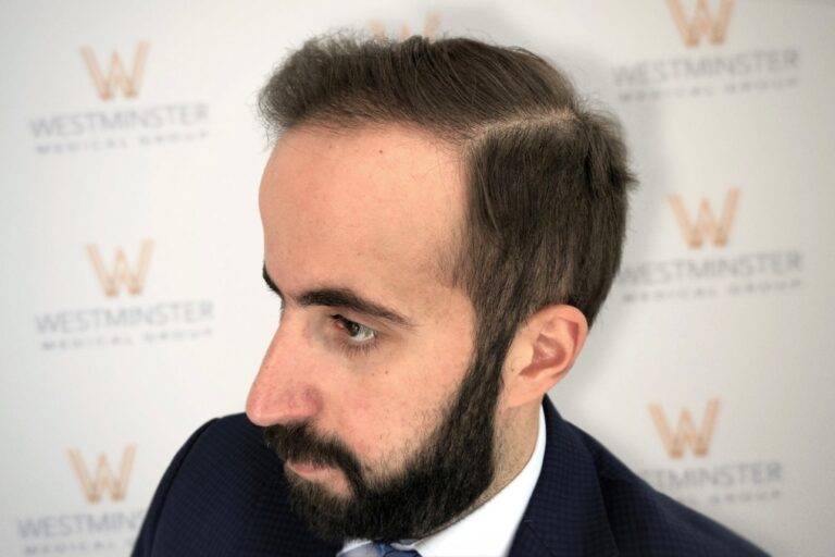 Hair Transplant Results 14