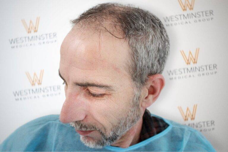 Hair Transplant Results 33