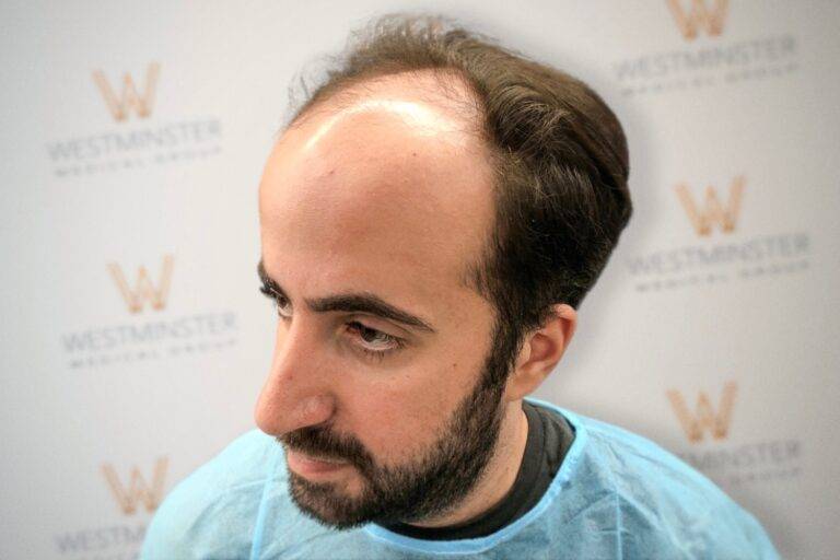 Hair Transplant Results 13