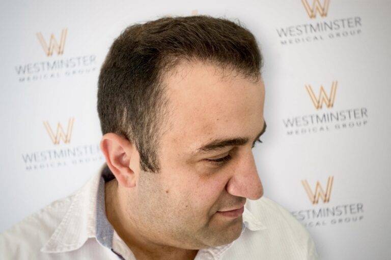 Hair Transplant Results 16