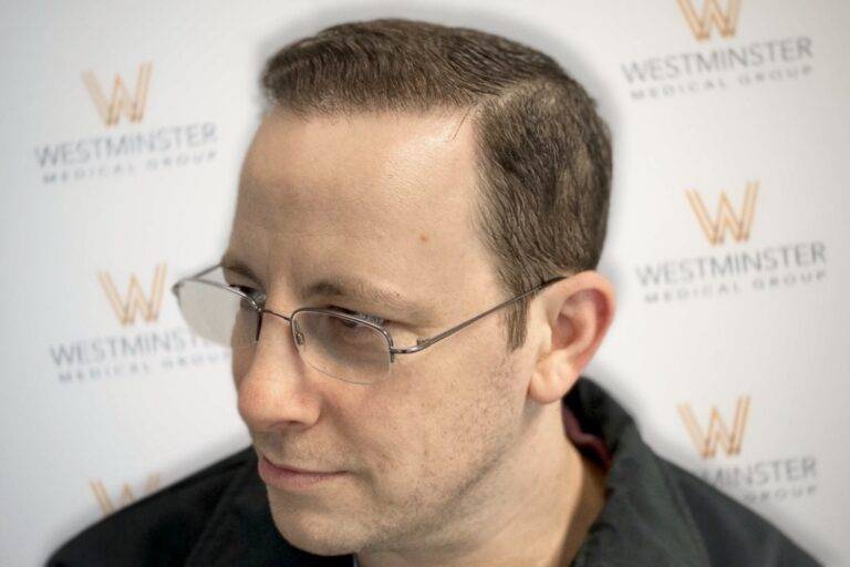 Hair Transplant Results 30