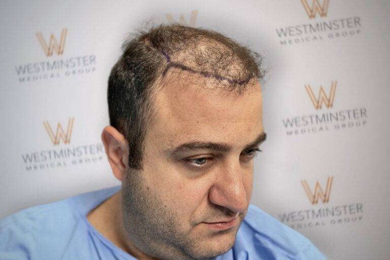 Hair Transplant Results 15