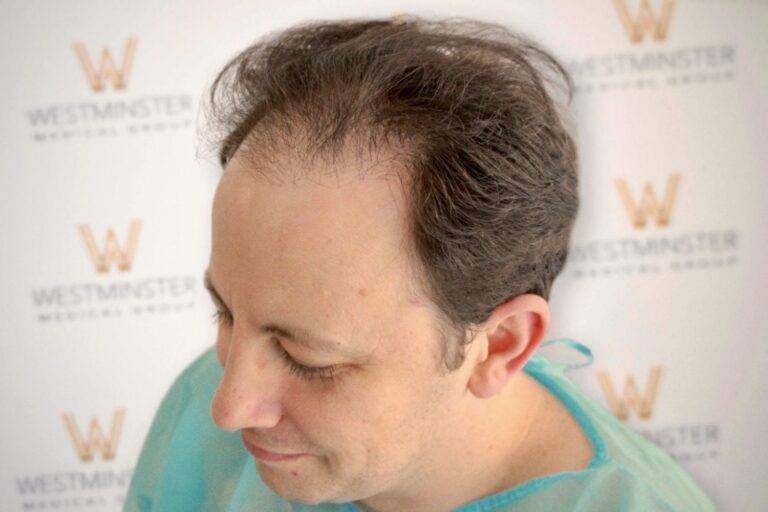 Hair Transplant Results 29