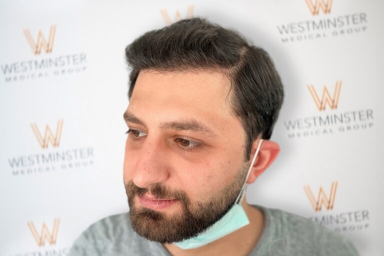 A man with a beard wearing a face mask around his chin, in front of a backdrop with "Westminster Medical Group" logos, specializing in hair implant treatments.