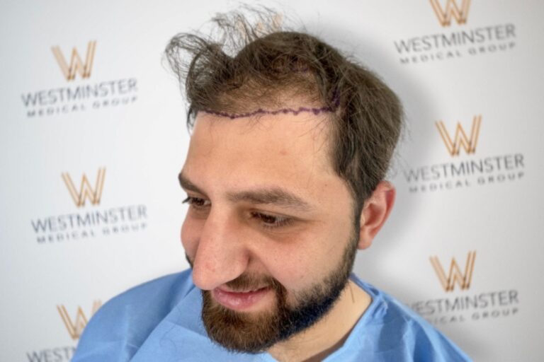 A man with a beard smiles gently, showing a purple line marking the hairline on his forehead, in a medical setting indicated by the "Westminster Hair Surgery Group" backdrop.