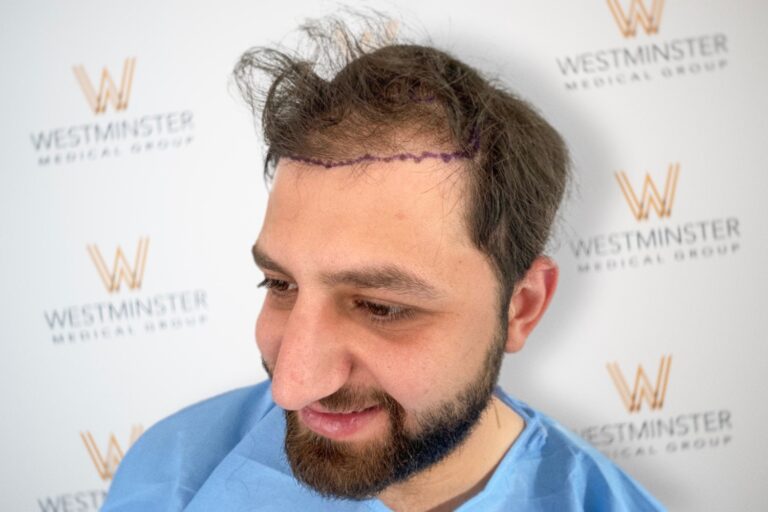 A man smiling gently, viewed from the side, with visible purple surgical markings on his partially bald head due to male pattern baldness, standing in front of a wall bearing the Westminster Medical Group logo.