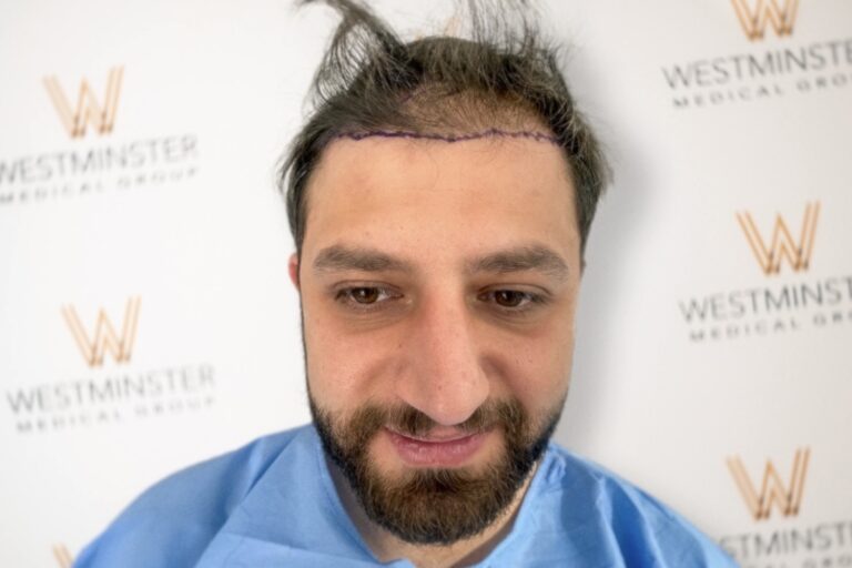 A man in a blue medical gown smiles slightly at the camera, with signs of male pattern baldness evident as marked areas on his scalp are visible against a backdrop with the Westminster Medical Group logo.
